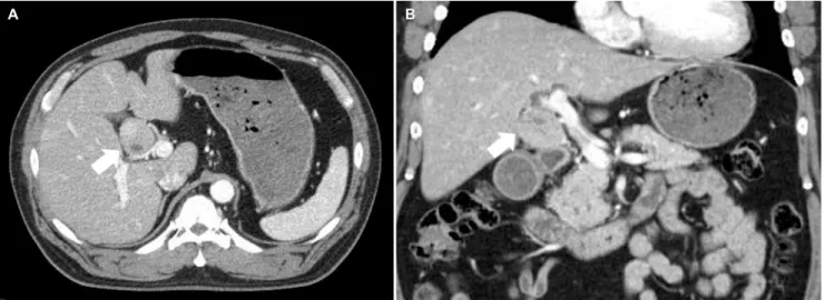 Fig. 1. (A, B) Contrast-enhanced CT image shows a 3.6×4.3 cm sized enhancing mass (arrows) in porta hepatis