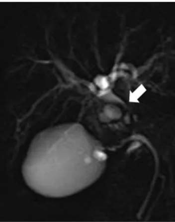 Fig. 4. Gross finding of the resected tumor shows a 4.7×4.5×3.5 cm sized protruding mass into the bile duct.