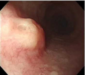 Fig. 3. Lifting of the subepithelial lesion of the esophagus with combination of saline solution, diluted epinephrine, and methylene blue (A), and post endoscopic mucosal resection result (B).