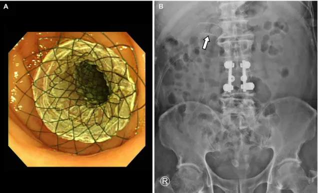 Fig. 4. Change in the negative suction drain amount after SEMS  insertion. SEMS, self-expandable metallic stent.