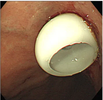 Fig. 1. The percutaneous endoscopic gastrostomy tube was inserted successfully.