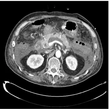 Fig. 5. Abdominal CT obtained 3 months after embolization showed  reduced peripancreatic fluid collection and improved pancreatitis
