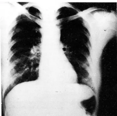 Fig.  3.  Chest:.  There  is  noted  pathologic  Îra- Îra-cture  in  post.  seg.  of  left  4th  rib  and  resorption  of  scapular  end  of  left  c1 avi c1 e