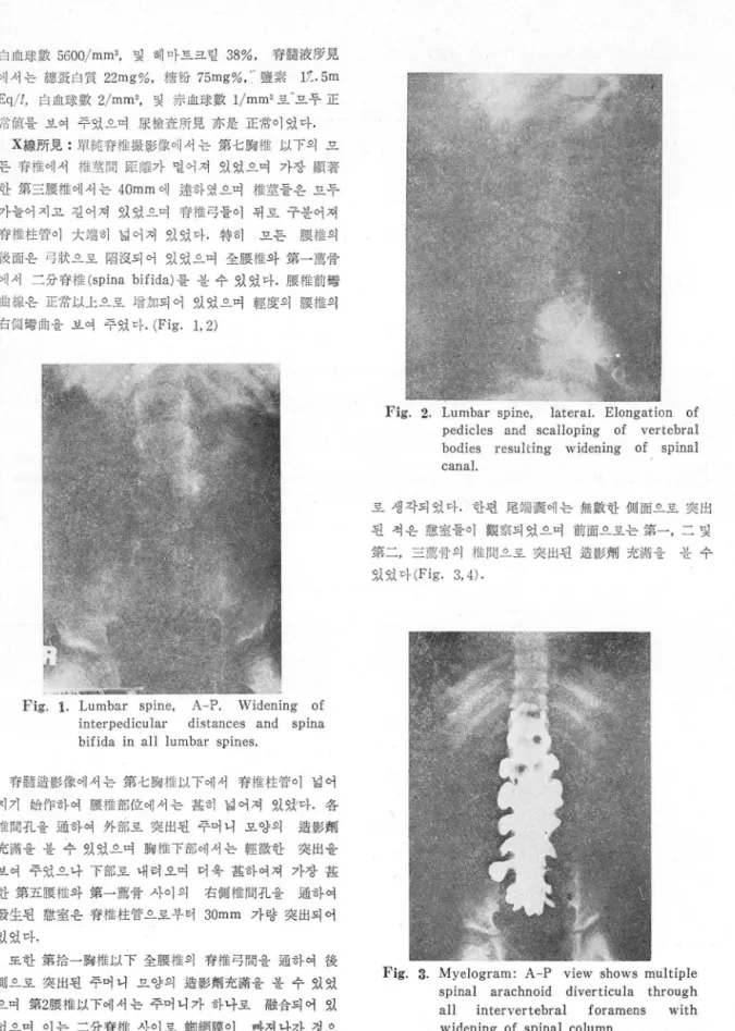 Fig.  3.  Myelogram:  A- P  view  shows  multiple  spinal  arachnoid  diverticula  through  aIl  in tervertebral  foramens  with  widening  of  spinal  column
