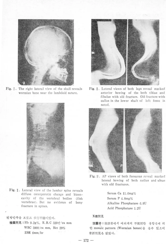 Fig.  I.  The  right  1atera1  view  of  the  sku Il  re、rea1s F ig.  m.  Late ral  views  of  both  1 egs  revea l  ma l  ked  wormian  bone  near  the  lambdoid  suture