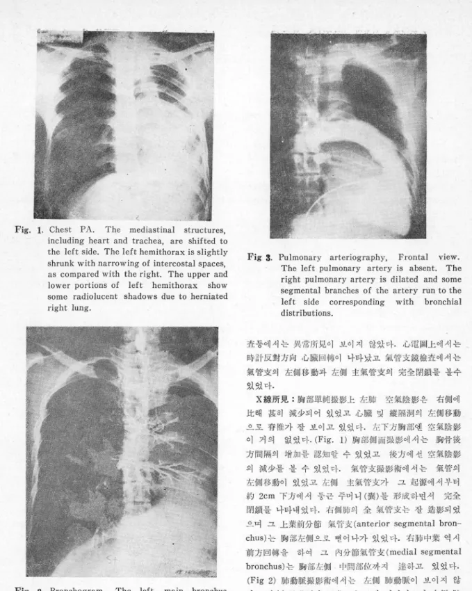 Fig.  2.  Bronchogram.  The  left  main  bronchus  t erminates  blindl y  2cm  distal  to  its  origin