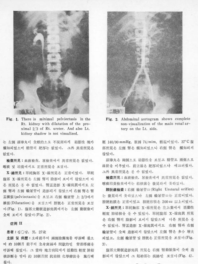 Fig.  1.  There  is  minimal  pelviectasis  in  the  Rt.  kidney  with  dilatation  of  the   pro-ximal  2/3  of  Rt