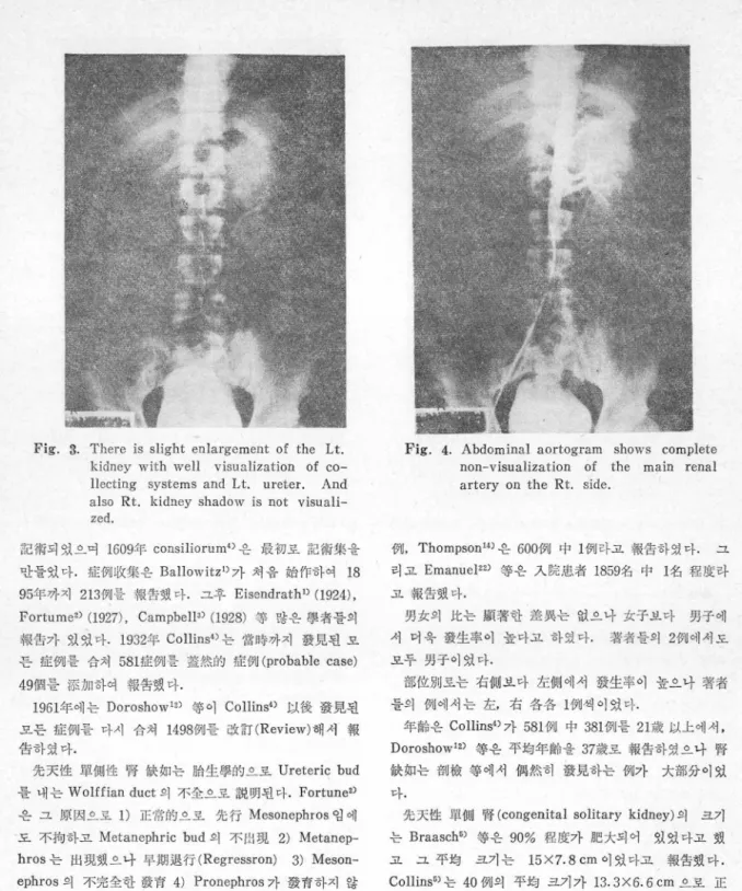 Fig.  3.  There  is  slight  enlargement  of  the  Lt. 