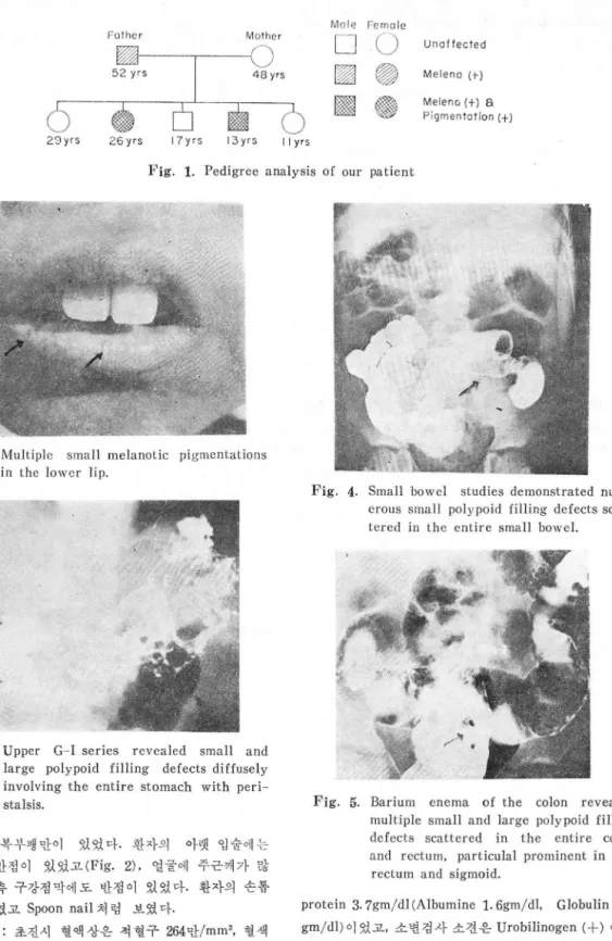 Fig.  1.  Pedigree  analysis  of  our  patient 