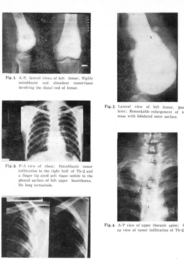 Fig. 1.  A- P ,  later a l  vicws  of  left  fe mur;  Highl y  osteoblastic  a ncl  abuncl a nt  tumort issue  involving  thc  c1 istal  encl  of  femu r
