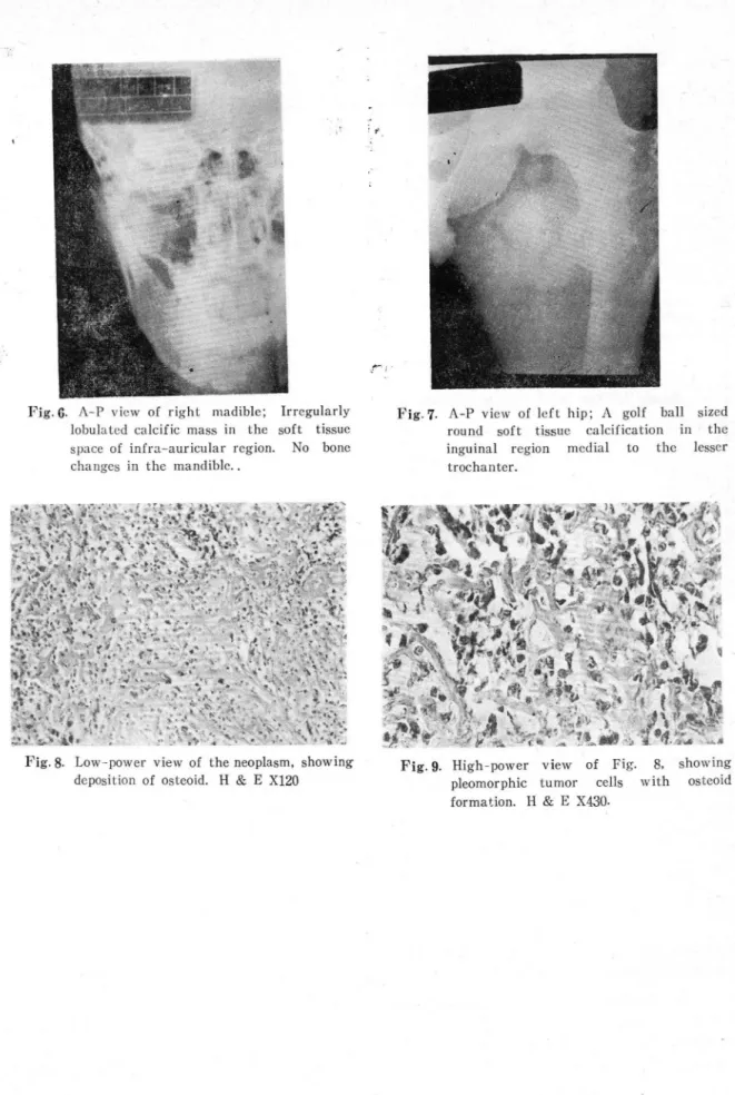 Fig. 9.  Hi gh - pow er  view  of  Fig.  8.  showi ng  pleomorphic  tUlllor  cells  w ith  osteoid  formation