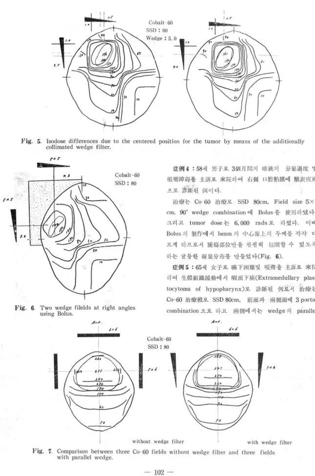 Fig.  6.  Two  wedge  fílelds  at  right  angles  using  Bolus. 