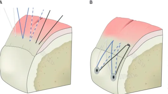 Fig. 1. A schematic drawing of the minimal  medial-row tie with suture-bridge technique