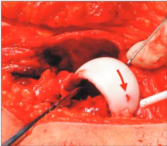 Fig. 6. Perfusion verification. A photograph showing good and permanent  perfusion of the epiphysis during the whole procedure, verified through a  2-mm perforation