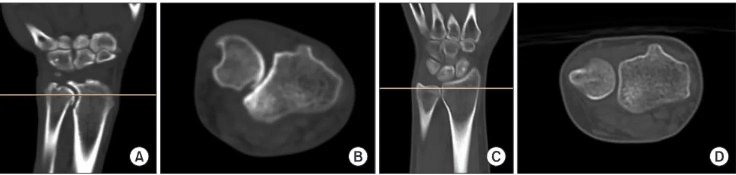 Fig. 2. Computed tomography (CT) images from the patient and control groups. (A) Coronal plane CT image showing the deepest sigmoid notch (SN)  in the patient group