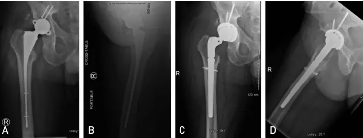 Fig. 3. After explant of infected prosthesis and insertion of antibiotic cement spacer, all patients received a minimum of 6 weeks of intravenous antibiotics followed by a 2- to 4-week antibiotic holiday, after which new infectious labs consisting of white