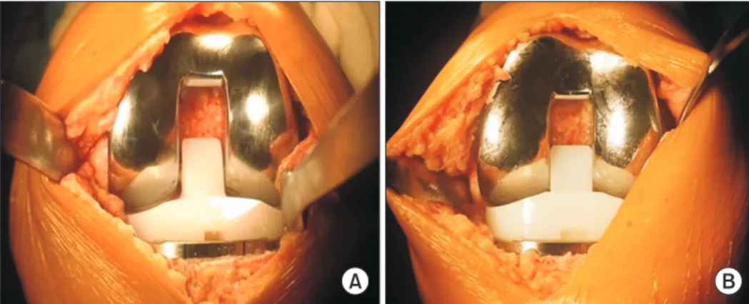 Fig. 1. Comparison between a posterior-stabilized (PS) insert (A) and constrained insert (B)
