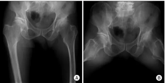 Fig. 1. A 56-year-old male patient with  bilateral hip involvement. Anteroposterior  (A) and frogleg (B) images show coxa  valga deformity and acetabular dysplasia  with marked degenerative changes in  the left hip