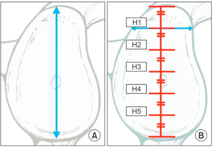 Fig. 2. Schematic illustration for measurements of the height (A)  and width (B) of the glenoid