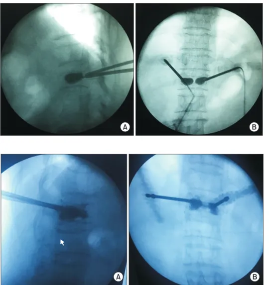 Fig. 2. The balloon was inflated to help  restore vertebral height and form a new  cavity
