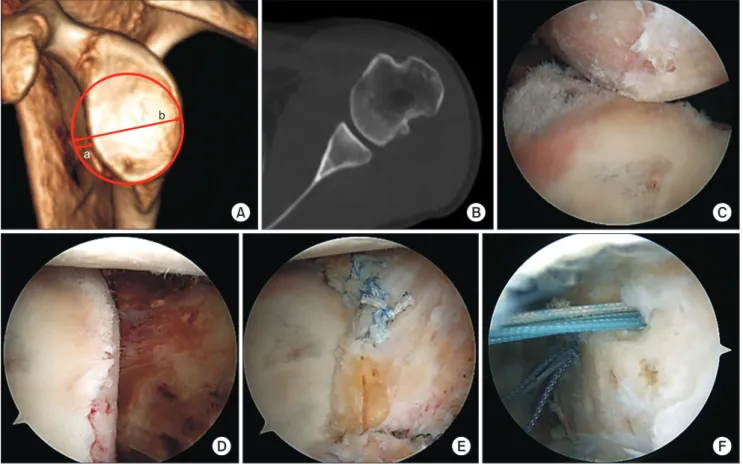 Fig. 1. A 38-year-old male with recurrent anterior instability of the left shoulder. All arthroscopic images were taken from an anterosuperior portal