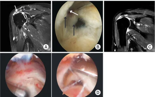 Fig. 1. Preoperative MRI and intraopera- intraopera-tive arthroscopic findings of full-thickness  delaminated rotator cuff tear