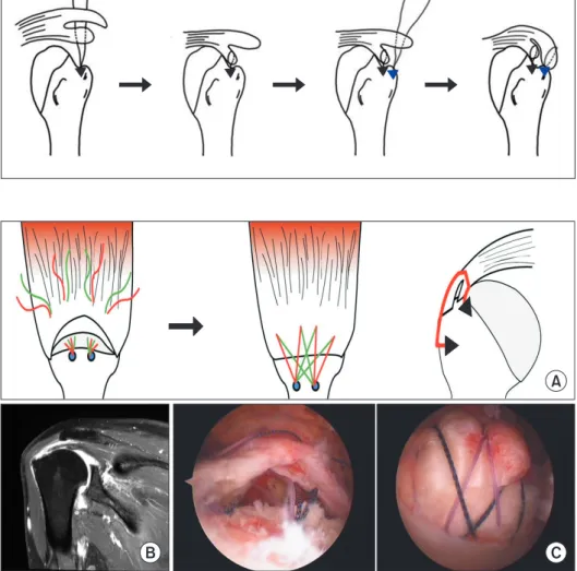 Fig. 3. Surgical repair of delaminated rota- rota-tor cuff tear using the double-row repair  technique
