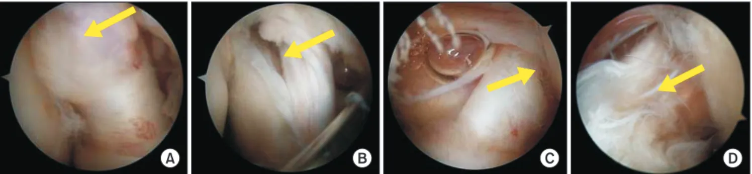 Fig. 1. Arthroscopic images showing stable lamination (A), unstable lamination (B), avulsion (C), and laminated avulsion (D) (arrows are indicating the tears).