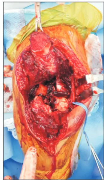 Fig. 2. Olecranon osteotomy.