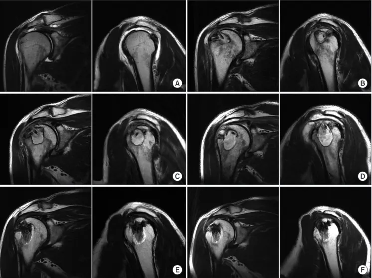 Fig. 1. Serial follow-up magnetic resonance imagings (MRIs). (A) Initial preoperative MRI, T2-weighted coronal and sagittal images