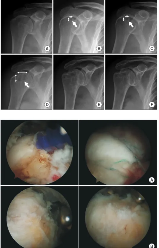 Fig. 2. Serial follow-up X-rays. The arrows  indicate the cyst. The left-right arrows  indi-cate the diameter of the cyst