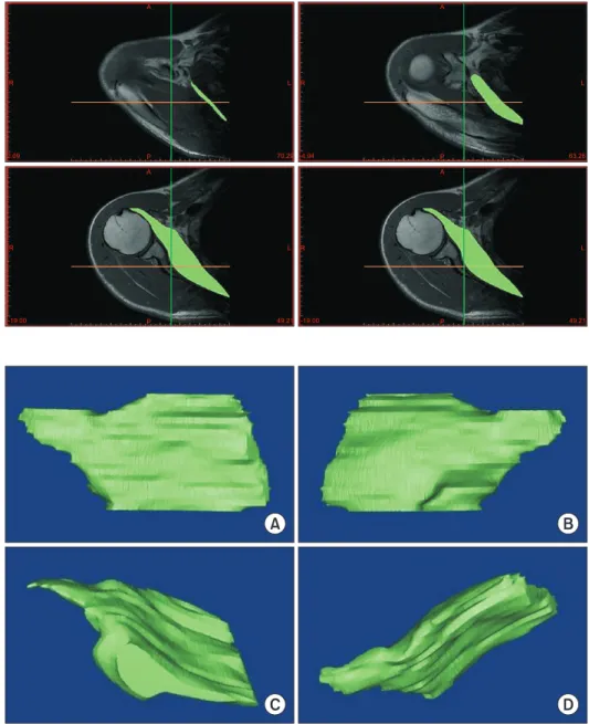 Fig. 3. Three-dimensional (3D) reconstruc- reconstruc-tion image of subscapularis muscle