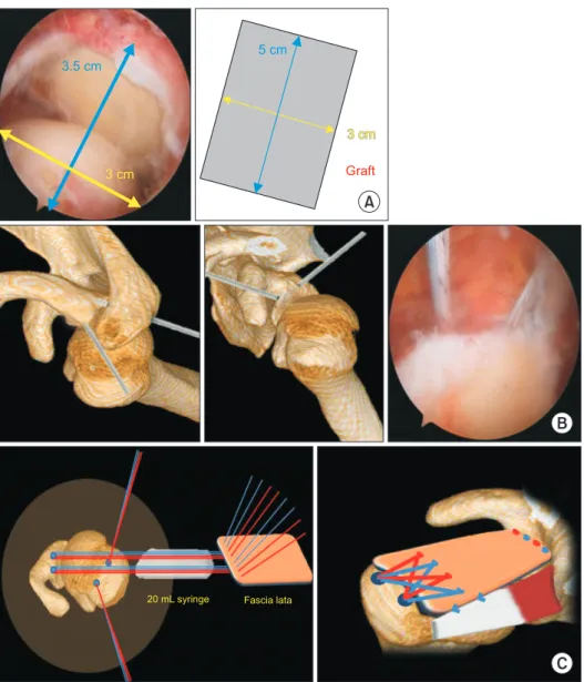 Fig. 1. Superior capsule reconstruction  procedure. (A) Graft preparation. (B)  Fixation of 4.5-mm diameter suture  an-chor