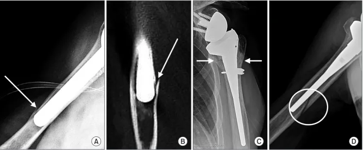 Fig. 2. Perioperative complications related to long stem humeral component, such as intraoperative humeral shaft fracture (arrows), during inserting press­fit, ce­