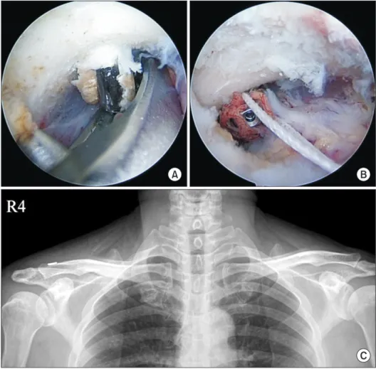 Fig. 4. Arthroscopic-assisted procedures  with a coracoclavicular suspension device. 