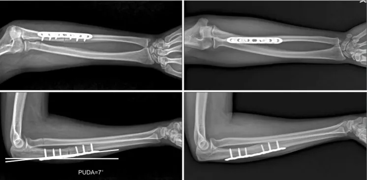 Fig. 3. The proximal ulna dorsal angulation (PUDA) was recovered by incomplete osteotomy on the back of the ulna at the deformation followed by tightening  the cortical screws to stick the bones to the pre-bent metal plate (right)