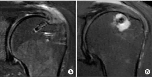 Fig. 3. Distribution of the grade of perianchor cyst formation between the  groups. Perianchor cyst formation is graded on T2-weighted coronal  mag-netic resonance imaging scan according to the classification of Kim et al