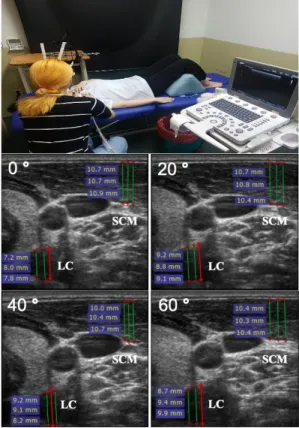 Fig.  2.  Ultrasound  imaging  of  LC  and  SCM  thickness during  Deep  Cervical  Flexor  exercise