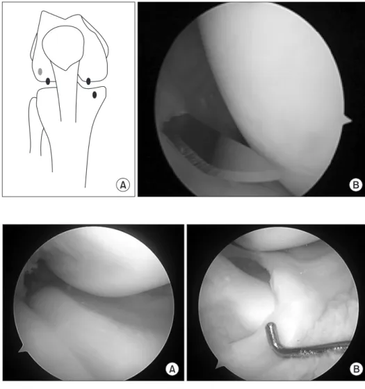 Fig. 3. (A) Arthroscopic findings of a thick  complete discoid medial meniscus in a  patient