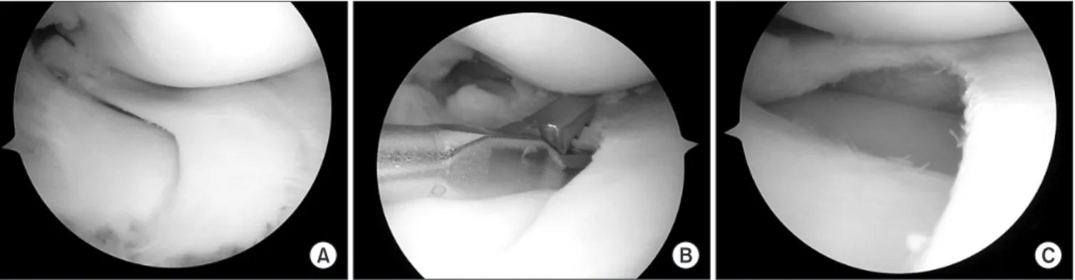 Fig. 7. Arthroscopically confirmed discoid medial meniscus (A) that underwent partial meniscectomy (B) preserving a 6 mm remnant margin (C).
