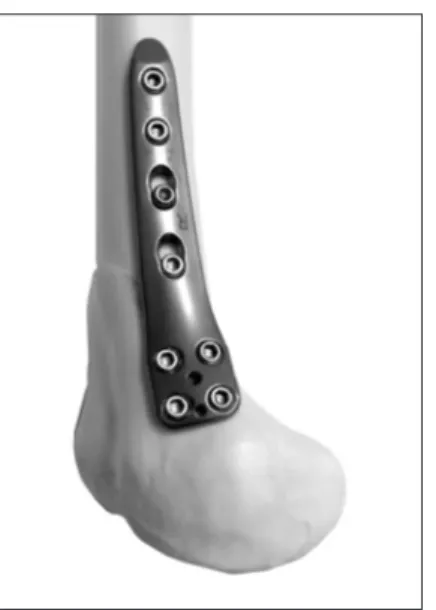 Fig. 1. Fitting of the TomoFix Medial Distal Femoral Plate (MDF; DePuy  Synthes GmbH) on the medial distal femur