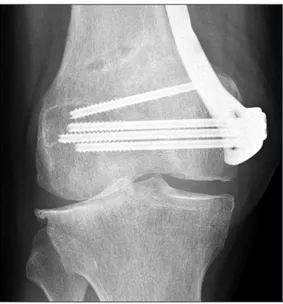 Fig. 4. Case 5. Anteroposterior view showing complete coverage of the  medial femoral epicondyle by the plate.