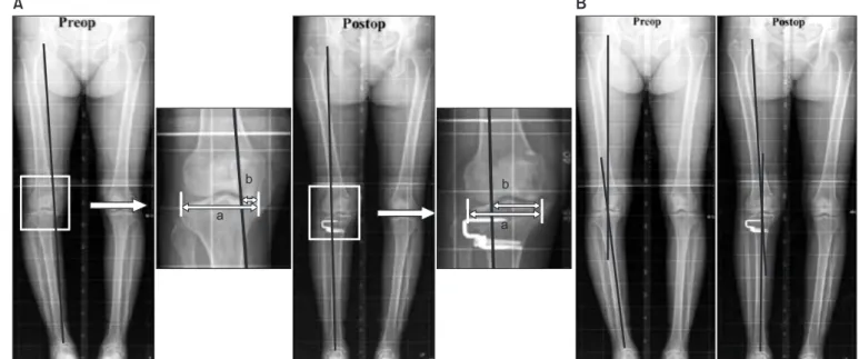 graphic measurements of the alignment and that post­osteotomy  MA would exhibit a wide dynamic range under external forces.