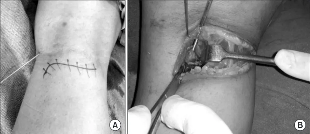 Fig. 4. Intraoperative photograph showing  the skin incision and fracture site with the  screw insertion technique.