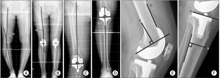 Fig. 2. (A) The radiograph shows the preoperative mechanical tibiofemoral angle (MTFA)