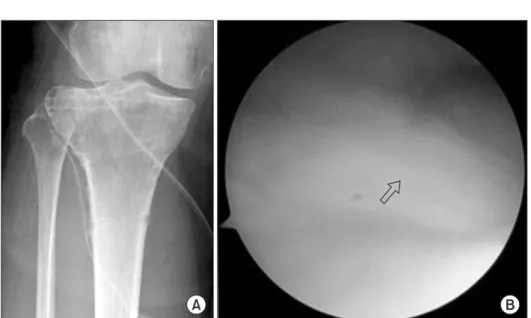 Table 2. Lateral Meniscus Tear Type