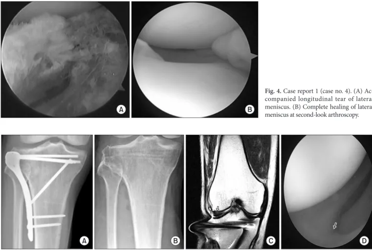 Fig. 5. Case report 2. (A) The immediate postoperative radiograph showing fixation by lateral plating