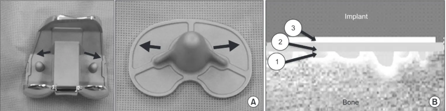 Fig. 1. (A) Cement pocket (arrow) for constant cement filling in the undersurface of an implant