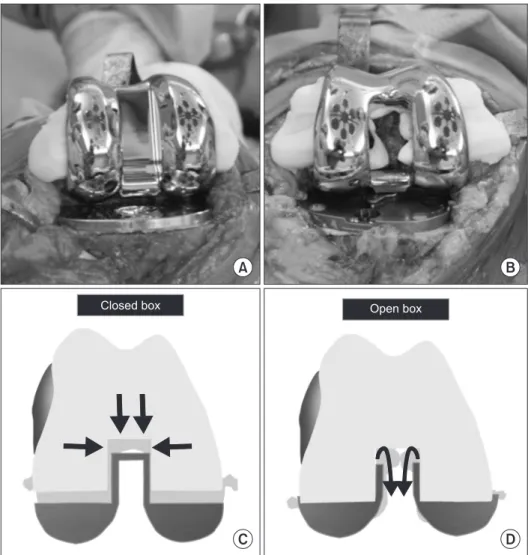 Fig. 3. (A, B) Cement leakage from the  periphery of the closed box type implant  and from the periphery and central box of  the open box type implant