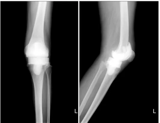 Fig. 1. Radiographs showing a mobile ce­
